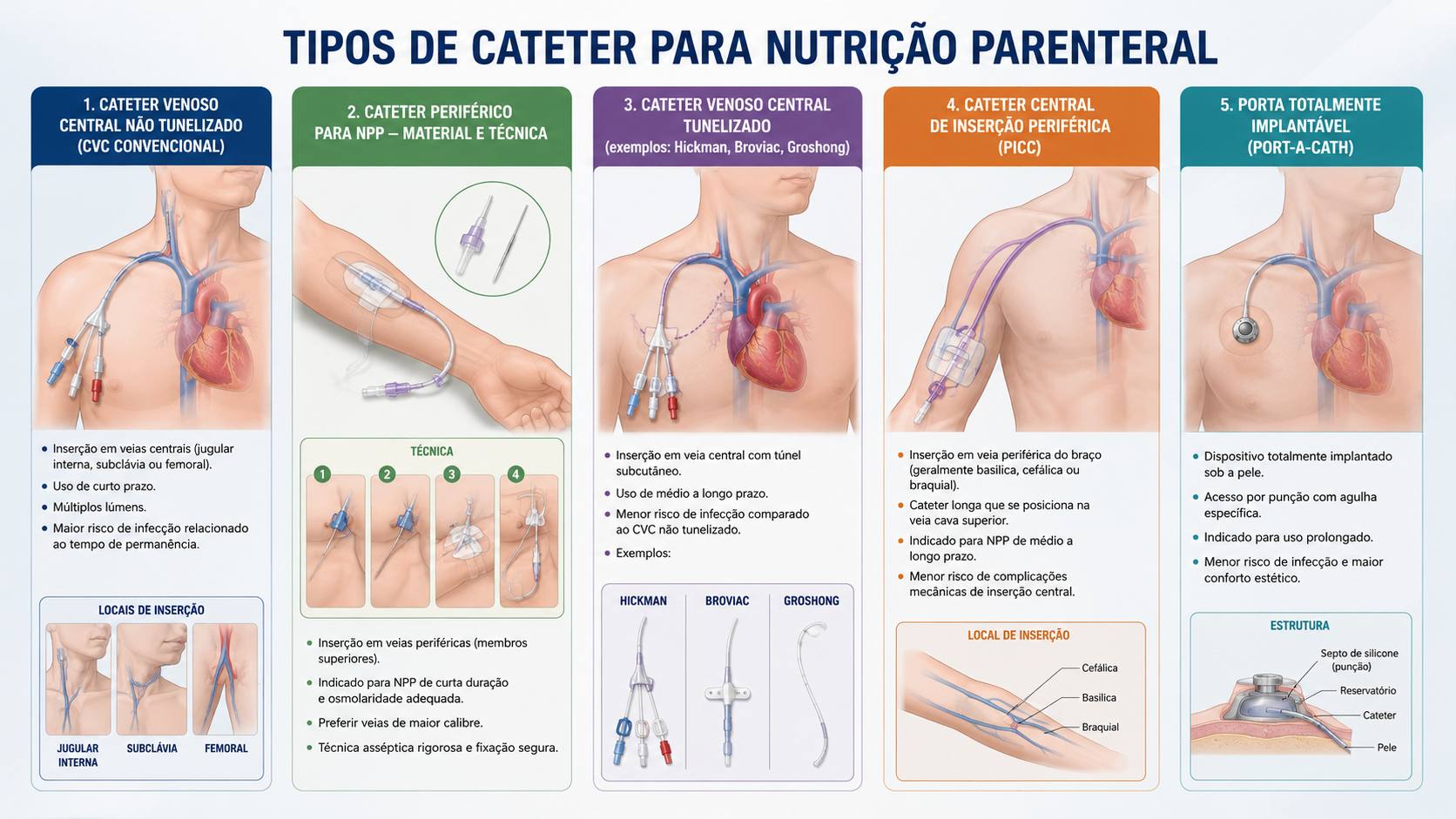 Diagrama dos diferentes tipos de cateteres para Nutrição Parenteral